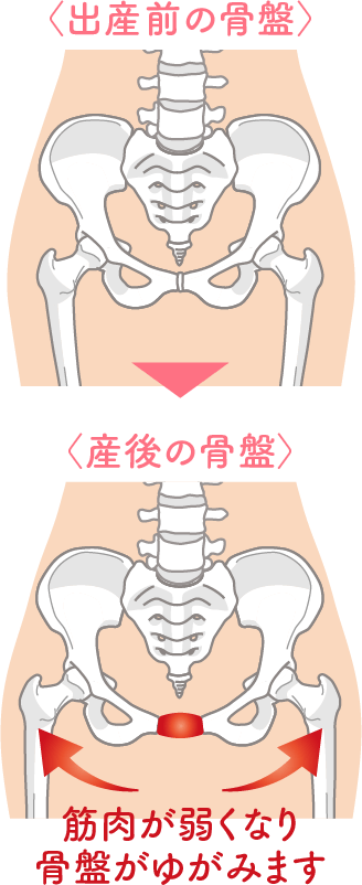 筋肉が弱くなり骨盤がゆがみます